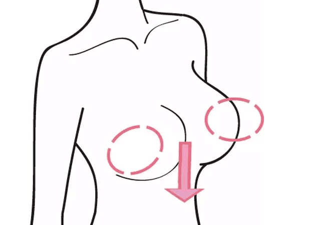 如何有效矫正乳房下垂